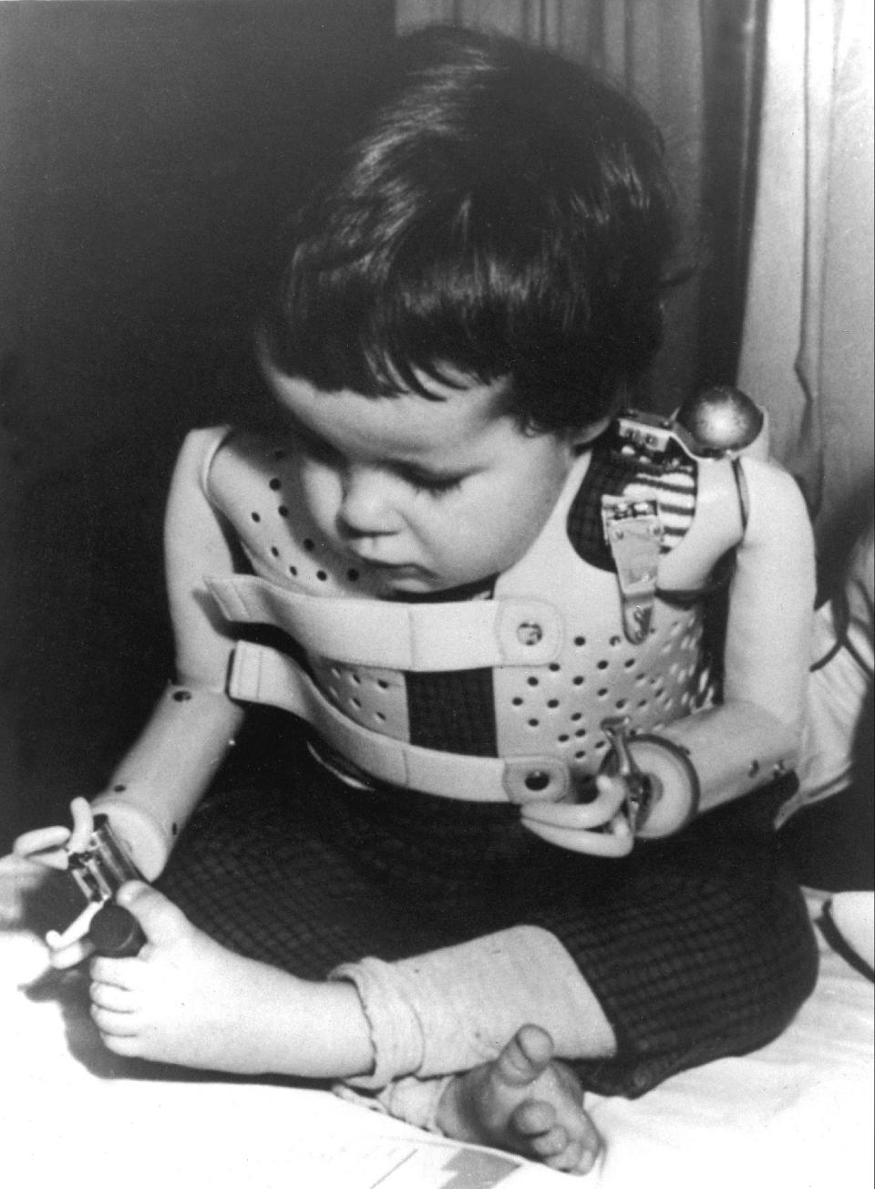 FILE - In a 1965 file photo provided by the U.S. Department of Health, a three-year-old girl, born without arms to a German mother who took the drug thalidomide, uses power-driven artificial arms fitted to her by Dr. Ernst Marquardt of the University of Heidelberg in Germany. Pharmaceutical company Gruenenthal, German manufacturer of anti-morning sickness drug thalidomide, has for the first time apologized to people who were born with congenital birth defects as a result of its use. Chief executive Harald Stock said Friday, Aug. 31, 2012 that the company had failed to reach out "from person to person" to the victims and their mothers over the past 50 years. (AP Photo/File)