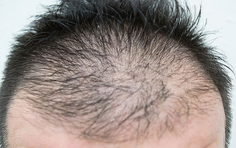 ▲多數男性落髮問題屬於雄性禿，是基因遺傳所造成，會因為賀爾蒙分泌異常引發掉髮。（示意圖，非本人／取自photoAC）