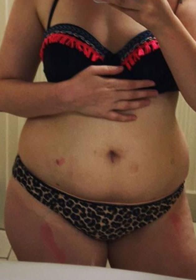 Endometriosis affects one out of every ten women. Photo: Instagram/lenadunham