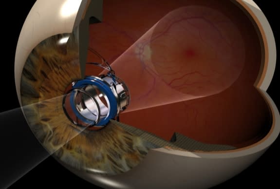 The implantable telescope technology reduces the impact of the central vision blind spot from advanced macular degeneration. The telescope implant projects the objects the patient is looking at on to the healthy area of the light-sensing retina