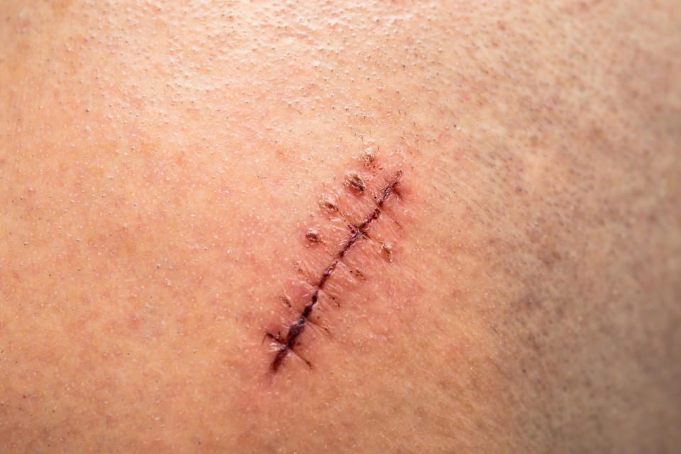 Se tatúa la misma cicatriz que una operación de corazón le ha dejado a su hijo de seis años en el pecho. (Foto: Getty Images)