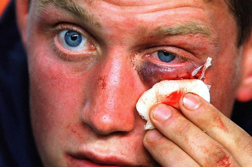 Ronan O'Gara tends to his injured face