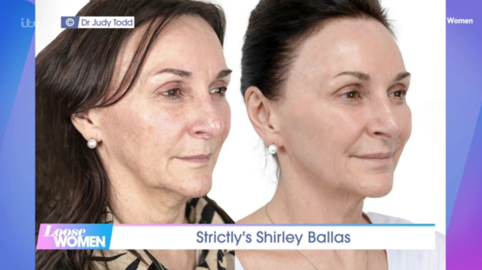 A composite aired on Loose Women shows Shirley Ballas’ before and after facelift photos (ITV/Loose Women)