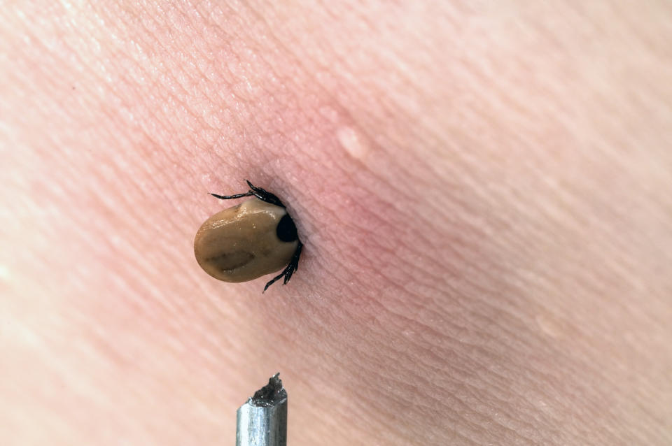 A female dog tick (Rhipicephalus sanguineus) stuck in the arm skin of a man in Summer