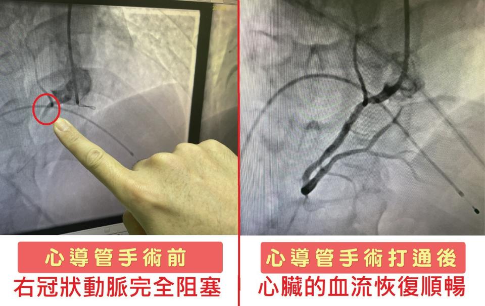 陳先生心臟血管術前堵塞(圖左)，術後恢復通暢(圖右)。烏日林新醫院提供