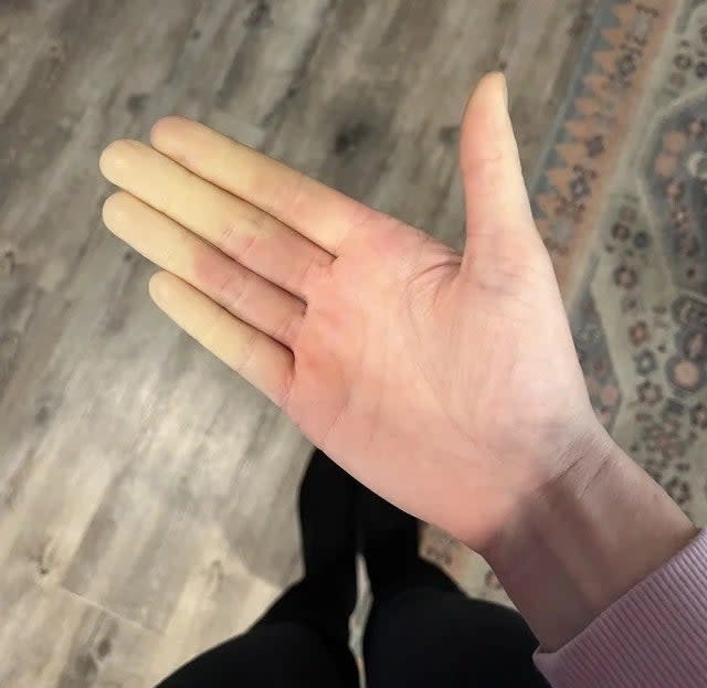 Every end of my fingers are curved up permanently : r/mildlyinteresting