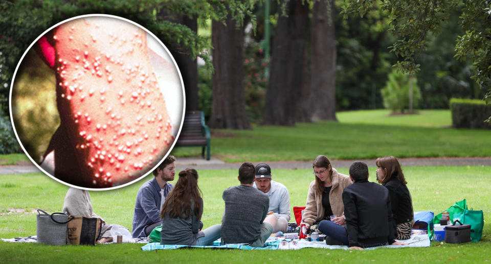 Inset - fire ant stings. Background - a group of people in a Melbourne park having a picnic.