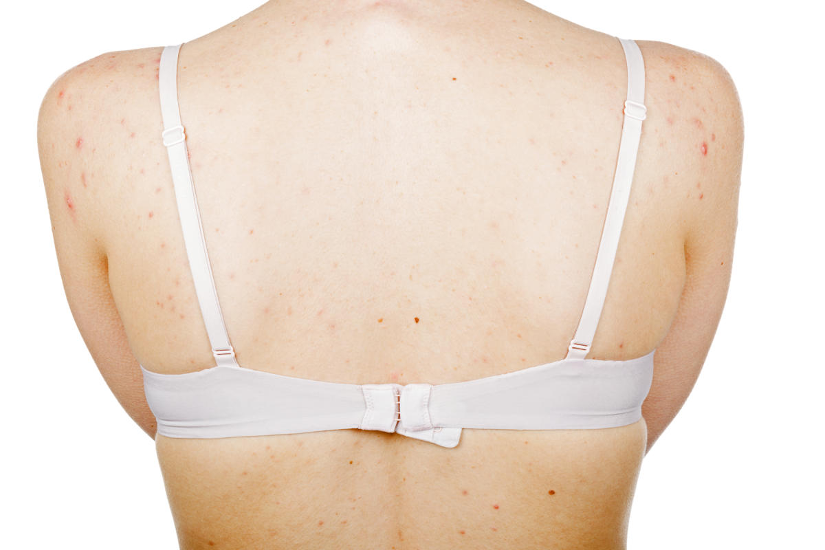 4 signs you could be allergic to your bra