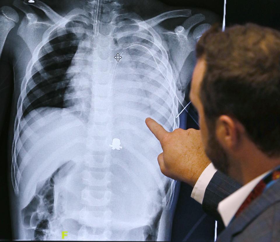 Dr. Nathan Heinzerling, pediatric surgeon and trauma medical director at Akron Children's Hospital, looks over an X-ray image of Tyren Thompson that shows the location of a bullet in the 7-year-old.