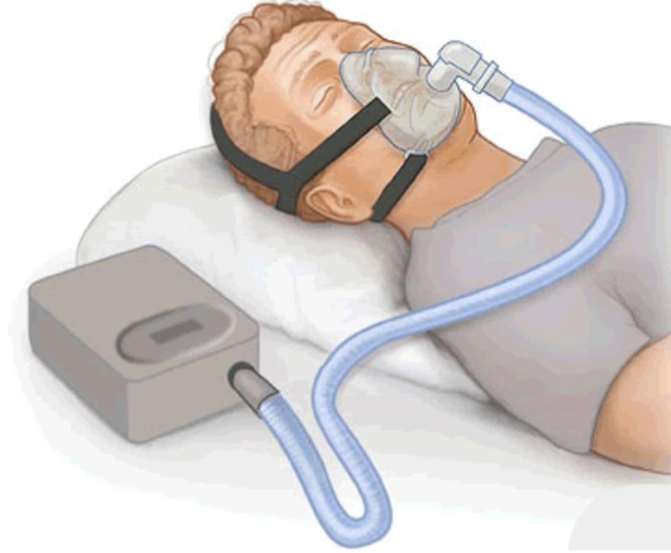 Dispositivo de presión positiva en las vías respiratorias. Foto: Wikipedia CC