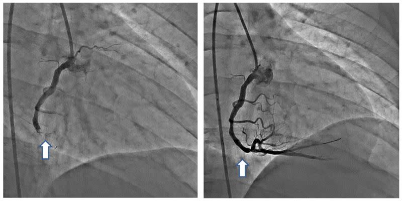▲26歲送貨員差點因心肌梗塞猝死，右冠狀動脈因血栓形成完全堵塞（左），立刻進行緊急心導管手術才撿回一命（右）。（圖／澄清醫院提供）