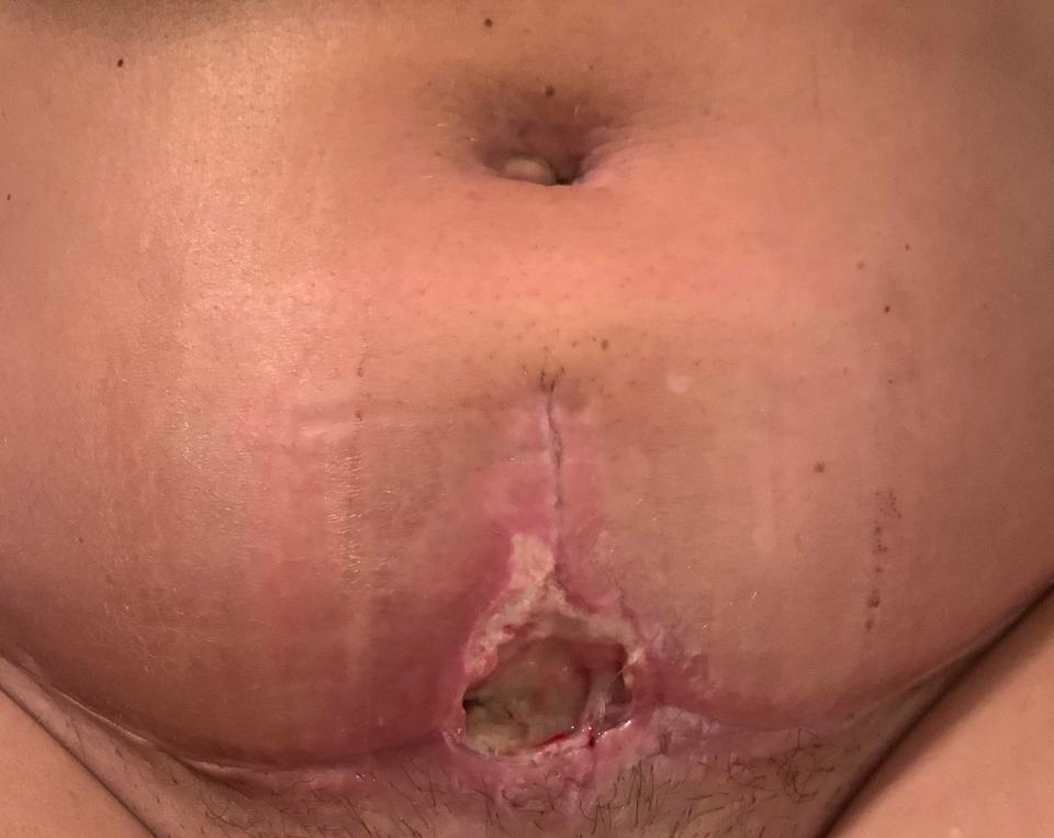 Brandi Fitzsimmons' stomach post surgery performed by Dr. Ben Brown in December of 2021. The incision in her stomach opened up after the staples were removed leaving a long, deep “tunnel” in her stomach, requiring two additional surgeries.
