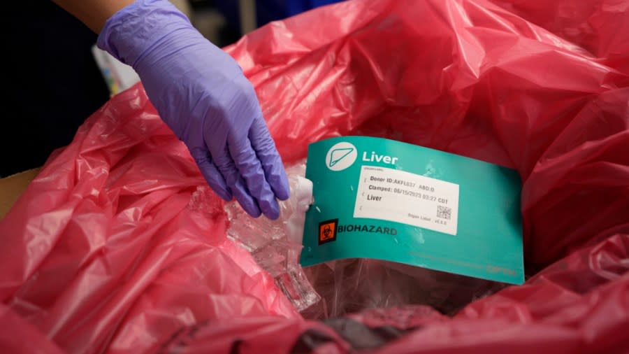 A liver is prepared for transport after it has been removed from an organ donor on June 15, 2023, in Jackson, Tenn. Cancer was later found in the donor’s lungs so the liver couldn’t be used for transplant. (AP Photo/Mark Humphrey)