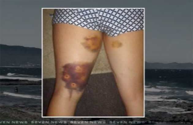 The puncture wounds Danielle suffered after an attack from dogs at East Corrimal Beach. Photo: 7News