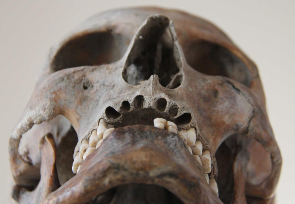 The approximately 700-year-old skull of a man from the now-submerged city of Rungholt. (Wolfgang Runge via Getty Images)