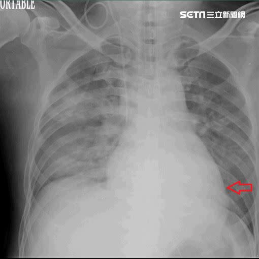 治療前心臟因發炎導致急性衰竭而肥大，併雙側肺水腫。（圖／台北慈濟醫院提供）