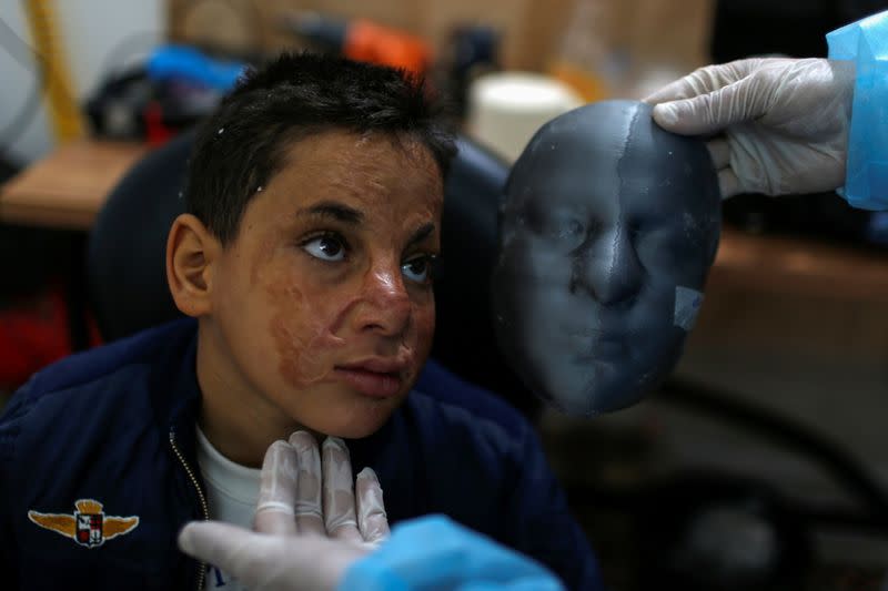 Gaza burn victims get 3D-printer face masks made close to home