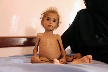 Malnourished Muath Ali Muhammad sits on a bed at a health center in Aslam district of the northwestern province of Hajja