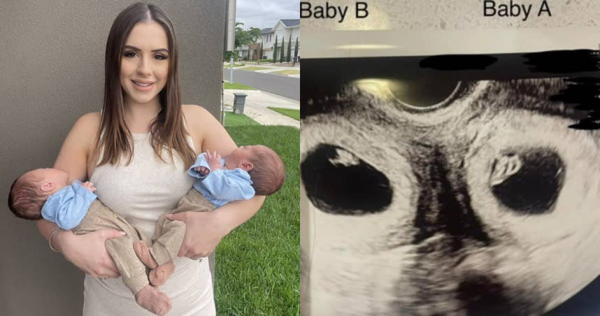澳洲墨爾本一名24歲女子瑪德琳（Madeline Kaklikos）擁有雙子宮，沒想到她竟懷上雙胞胎，1個是試管嬰兒；另1個則是自然受孕，罕見案例發生的機率只有5千萬分之一。（圖／Twitter／@crescer、@whatsn2day）