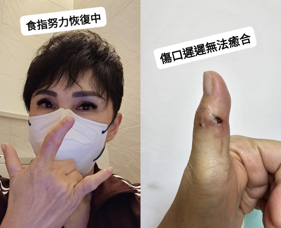 王瑞玲1個月前手指開刀，傷口至今未癒合。（圖／翻攝自王瑞玲醫藥美食記者臉書）