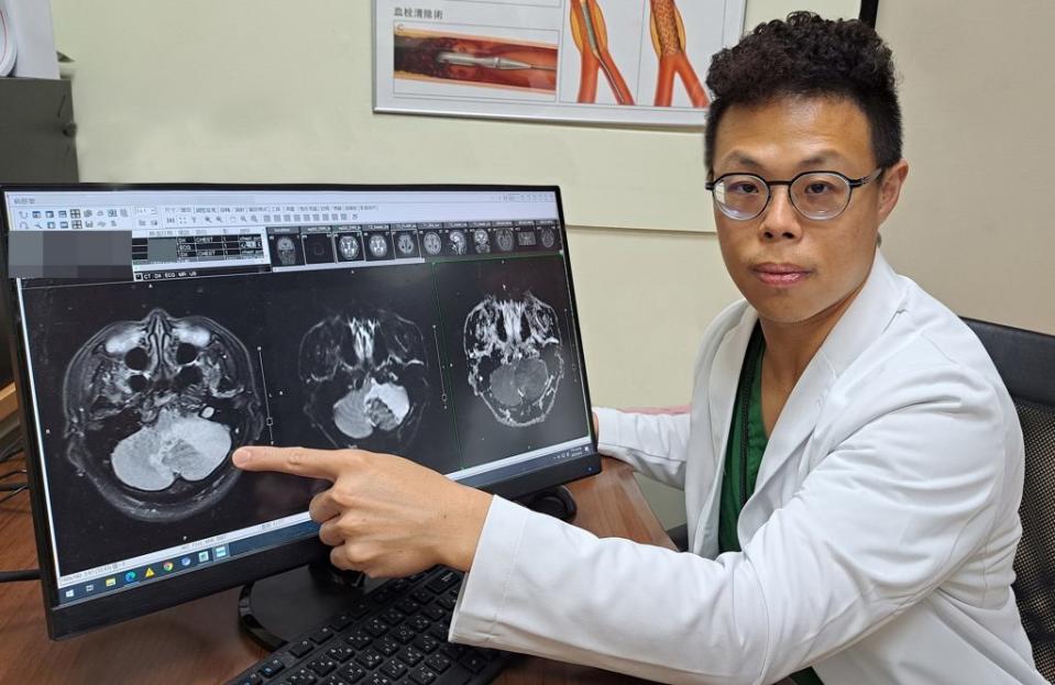 醫師王壹指出，中風患者經磁振造影顯示梗塞性腦中風復發。（記者吳瀛洲攝）