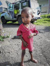 In this photo provided anonymously, a severely malnourished child is seen at the Ayder Referral Hospital, where medicines have almost run out and hospital staffers haven't been paid since June, in Mekele, in the Tigray region of northern Ethiopia in September 2021. For months, the United Nations has warned of famine in Tigray and now internal documents and witness accounts reveal the first starvation deaths since Ethiopia's government in June imposed what the U.N. calls "a de facto humanitarian aid blockade." (UGC via AP)