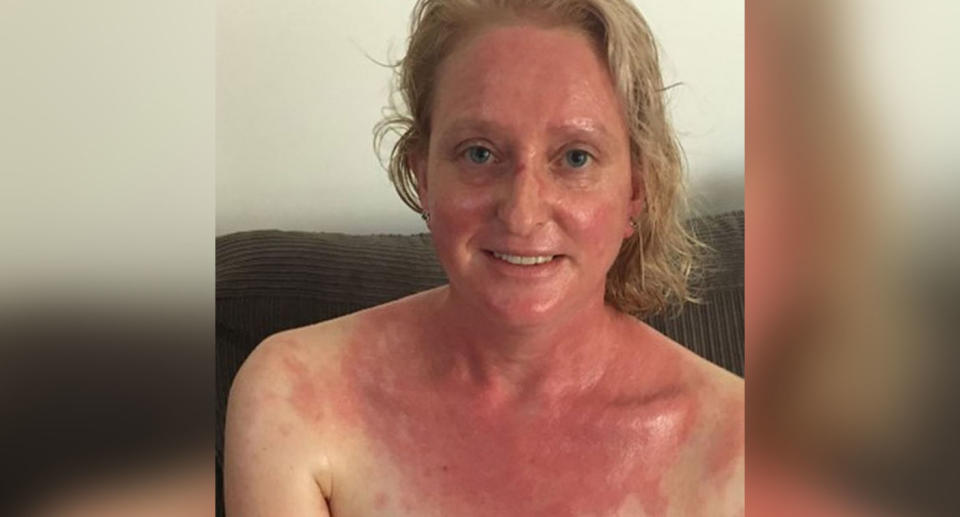 The mum of four said before 2016 she was generally healthy, but particular in the last year has experienced the debilitating rash. Source: Supplied.