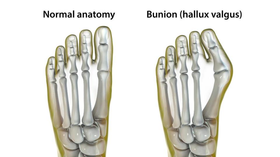 bunion exercises: Hallux valgus, also known as bunion, illustration. Hallux valgus is an abnormal deviation of the big toe, which leads to a deformation at the front of the foot at the first metatarsal and the big toe