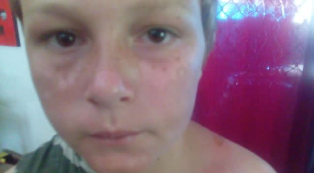 Wade was also left in pain, despite her mother saying he wore the sunscreen. Photo: Supplied/ Vanessa Munroe