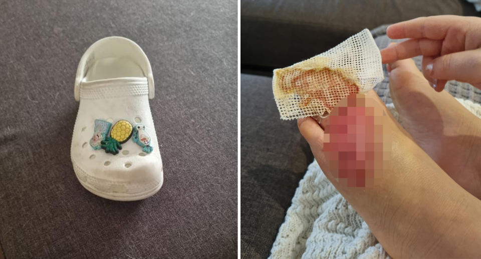 A photo of the child's non-damaged Croc, while the one in question was ripped. Another photo of the injury on the child's foot.