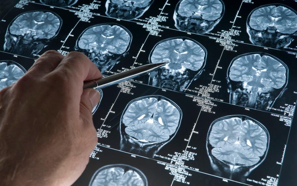 Sufferers with treatable mind illness are being misdiagnosed with dementia, professionals warn