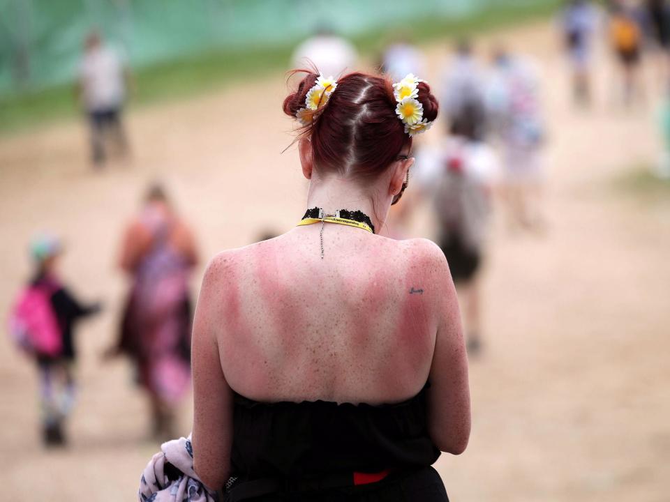 UK weather: Health warning issued after hundreds treated for sunburn during heatwave