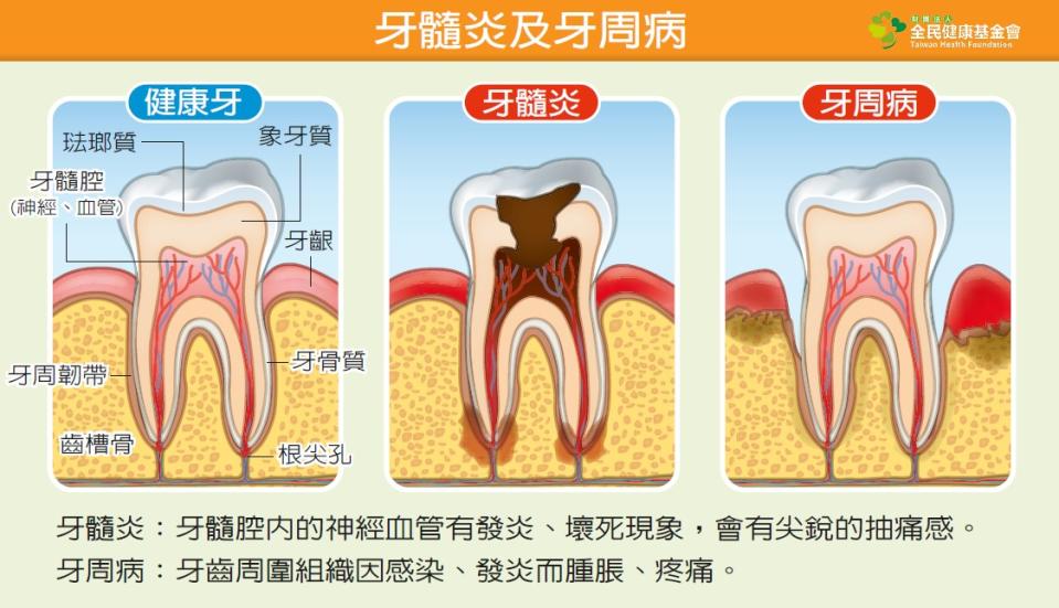 牙髓炎及牙周病