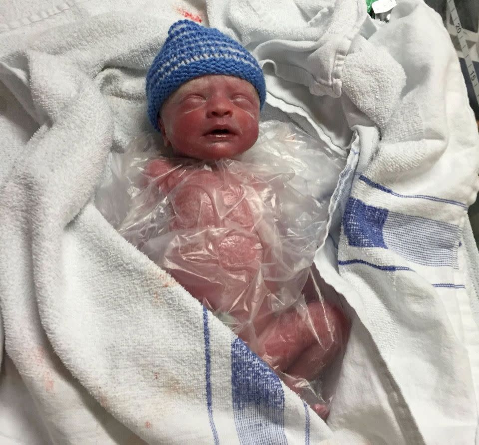 Nurses placed little Isaac in a plastic bag to keep him alive after his premature birth. Photo: Yahoo UK