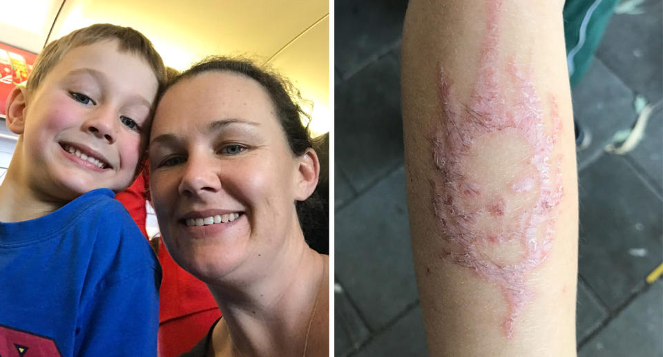 Pictured is Perth mum Louise Byrne and son Logan, who was left scarred by a temporary henna tattoo he got in Bali, Indonesia.