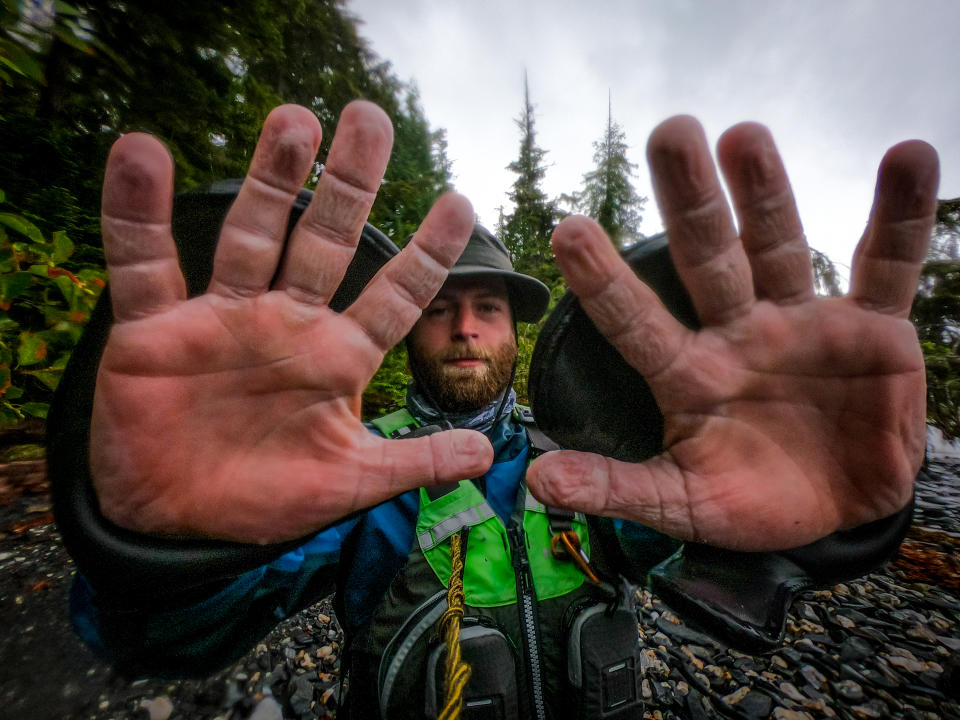 Chris Whittaker’s swollen hands (Collect/PA Real Life)