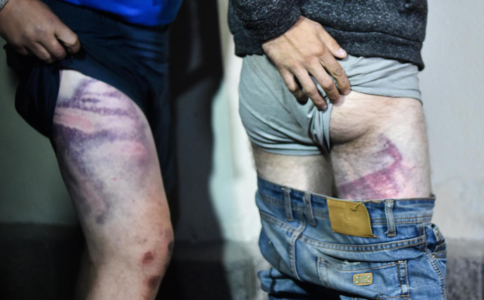 People detained during opposition rallies show bruises they say were sustained during beatings as they leave the Okrestina prison in Minsk, August 14, 2020. / Credit: SERGEI GAPON/AFP/Getty