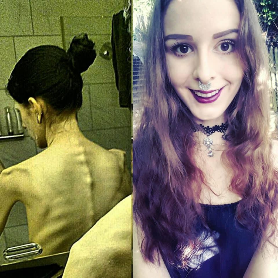 Julia before and after her treatment for anorexia. Photo: Triangle News