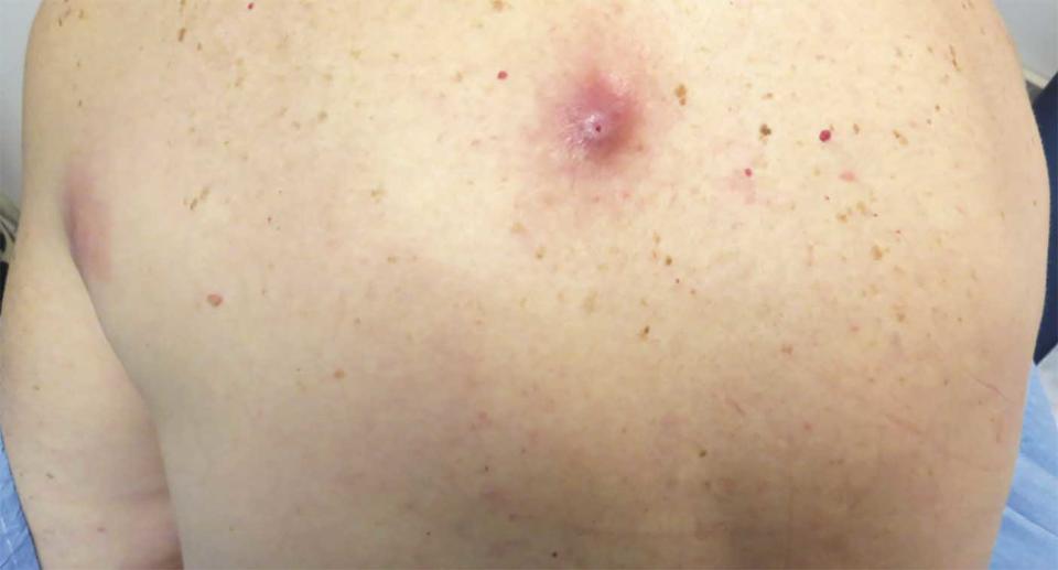 A nodule is seen on a 62-year-old woman's back as she deals with myiasis.