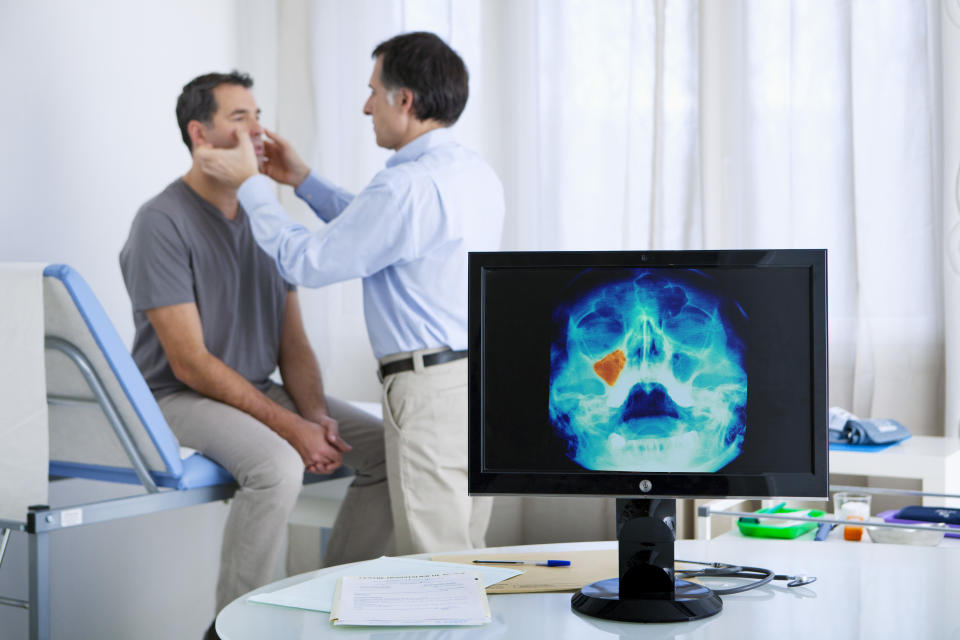 X-ray showing a maxillary sinusitis.