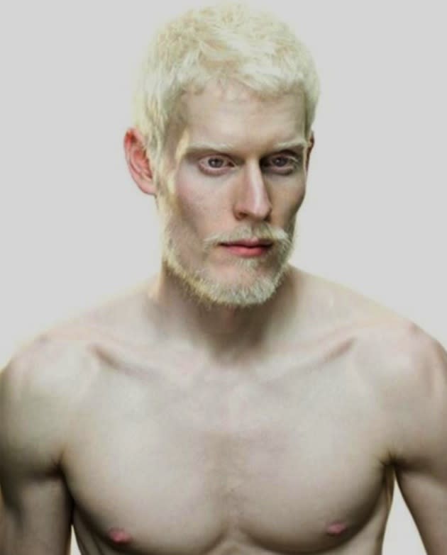 A beleza exótica dos albinos