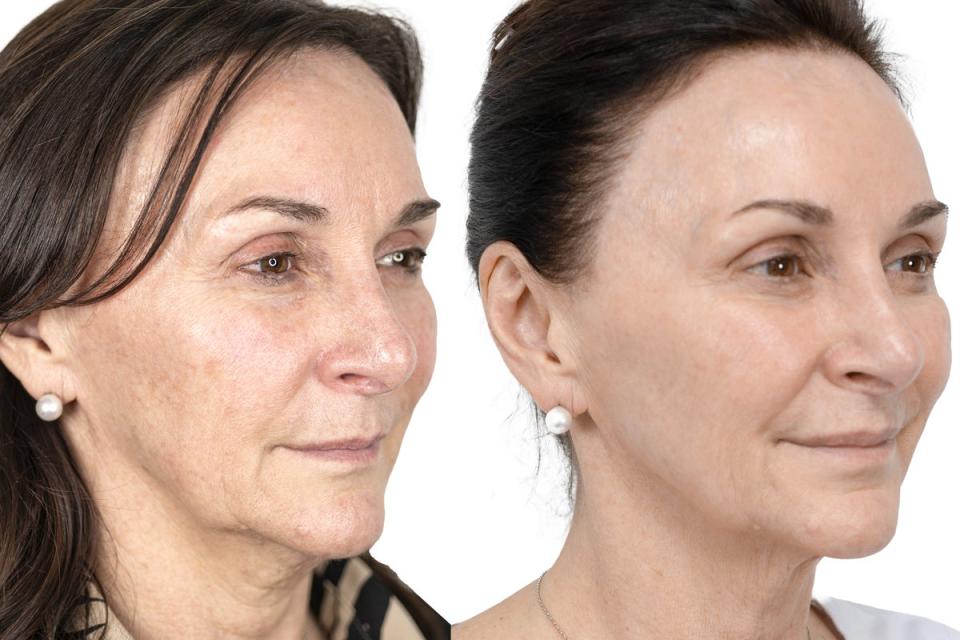 Shirley Ballas before and after the treatments (Dr Judy Todd)