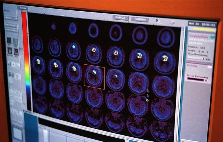 El estudio se basó en tomografías cerebrales de casi 40.000 adultos de entre 44 y 82 años que residen en Reino Unido