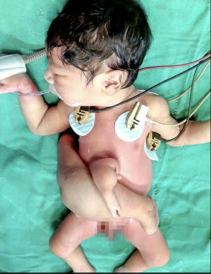Four doctors worked to remove the boy's extra arm, legs and penis at a hospital in Jaipur. Source: CoverAsia Press
