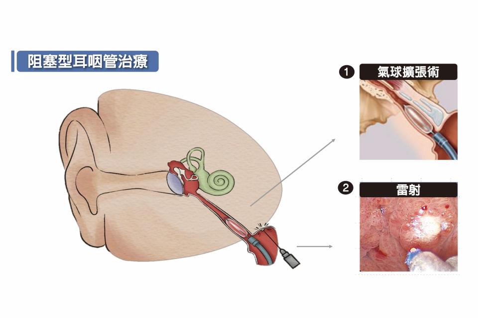 阻塞型耳咽管治療示意圖。