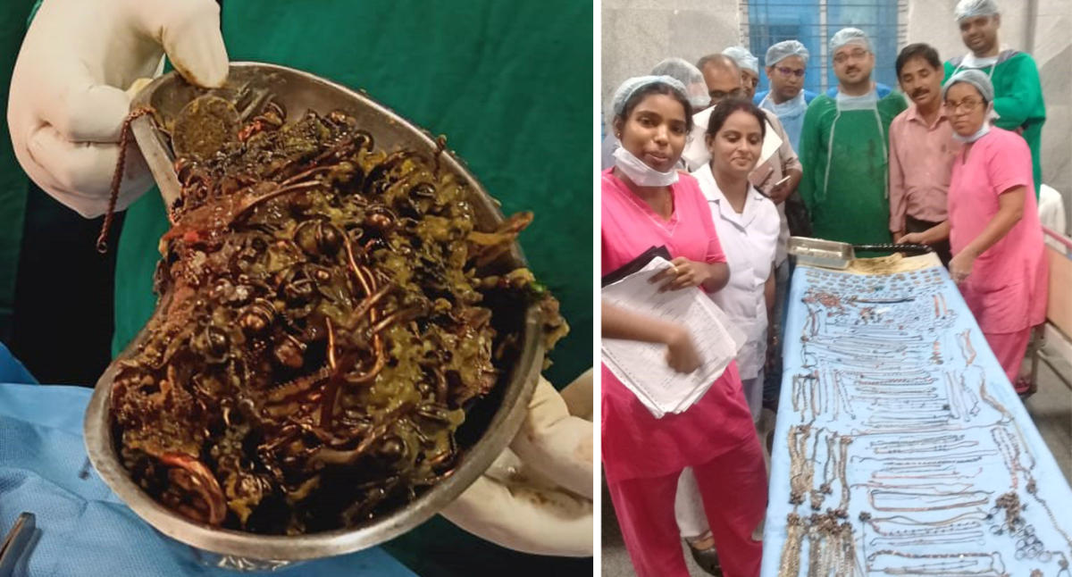 Doctors remove 1.6 kg of metal from a woman’s stomach in India