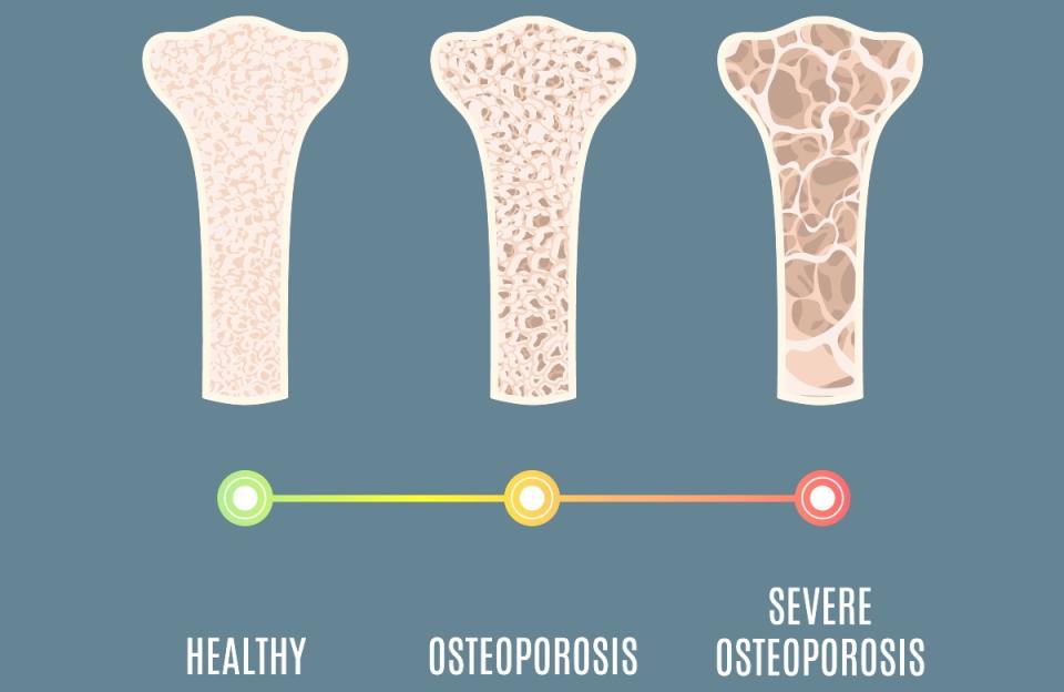 Illustration of the stages of osteoporosis