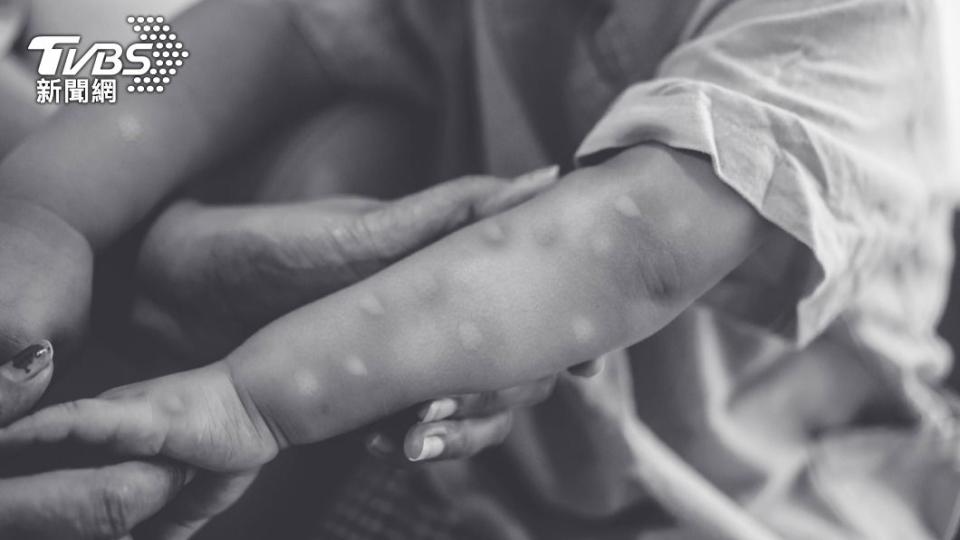 法國出現首名兒童感染猴痘。（示意圖／shutterstock達志影像）