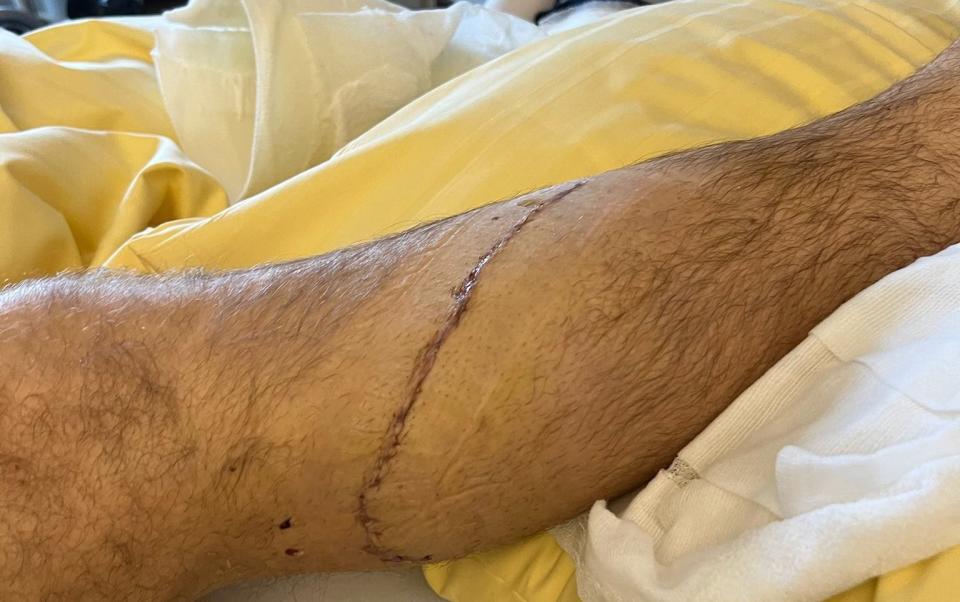 Aleksander Aamodt Kilde's leg is stitched after his skiing accident