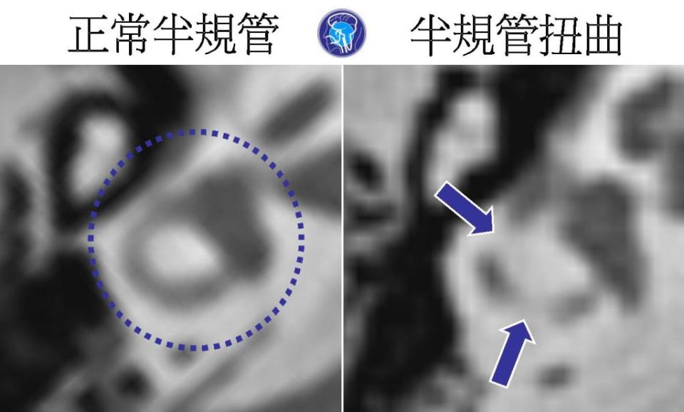 內耳電腦斷層檢查顯示，左圖為正常半規管，在一平面上呈現圓環狀（虛線圈）；右圖為扭曲半規管，無法在一個平面上呈現圓環，而是一節一節的（藍色箭頭處）。（醫師陳建志提供）